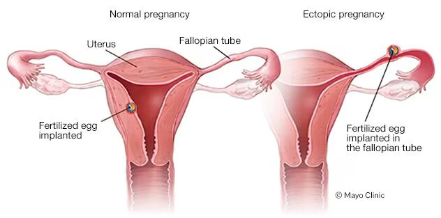 Ectopic Pregnancy